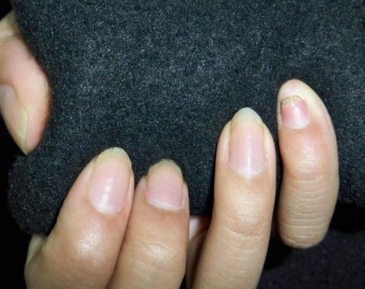 Figure 5: 50% growth of healthy nail.