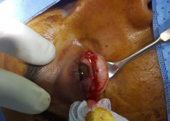 Figure 1: Conjunctival step.