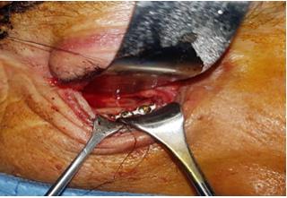 Figure 4: Reduction of the bone fracture and osteosynthesis with titanium miniplates.