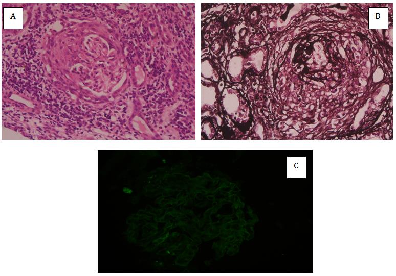 Figure 3: Pauci-immune crescentic glomerulonephritis. A) Crescent on H&E staining, B) Crescent on silver staining, C) No immune deposit on DIF.