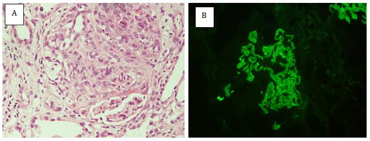 Figure 4: Anti GBM disease. A) Crescent on H&E staining, B) Linear deposits of IgG along the glomerular capillary wall.