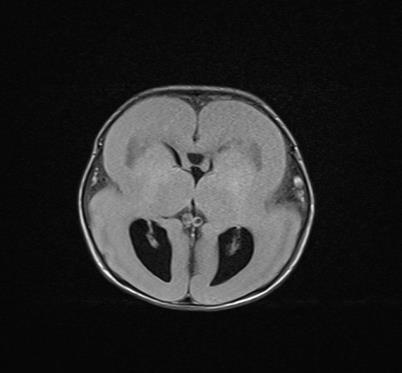 Figure 1: Magnetic Resonance Image (MRI) that suggest lissencephaly.