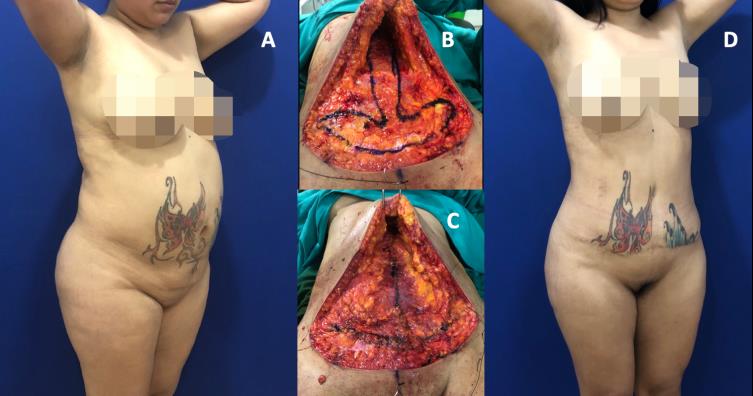 Figure 4: A 28-year-old female patient, to whom she performed secondary liposculpture, lipoabdominoplasty with anchor plication and neoumbilicoplasty. Preoperative view. B and C. Show the aponeurotic muscle plication performed. D. Results obtained 6 months later.
