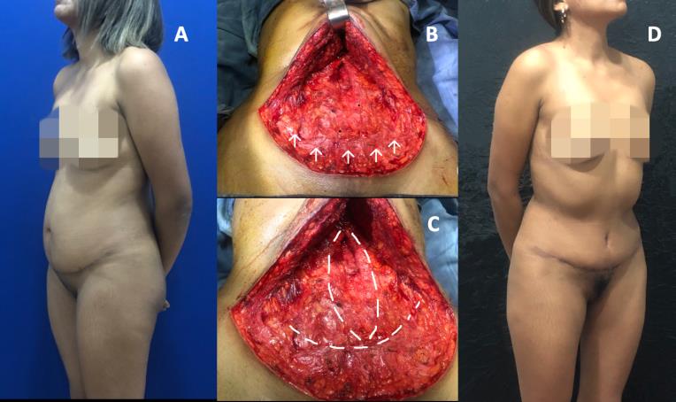 Figure 5: The patient 32 years operated 6 months before mini-lipoabdominoplasty using the TULUA technique. A. Preoperative photo. B. Horizontal plication performed in the first surgery (arrows). C: Design of the complementary, vertical Plicature. D: Photo at 3 months postoperatively.