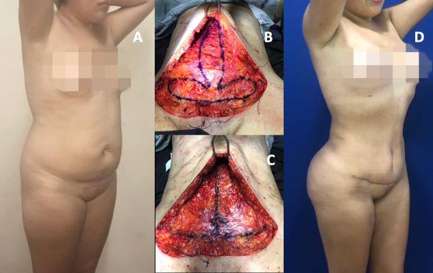Figure 6: A 36-year-old patient performed lipominiabdominoplasty with Plicature in "Fleur de Lys." Preoperative photo. B. Plication design. C. Plication finished. D. photo of 5 months postoperatively.