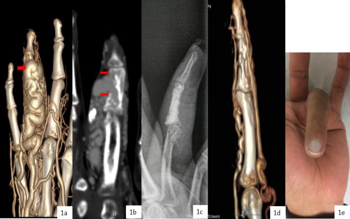 Figure 1: AVM of the 4th finger in 33 years-old adult manual worker. a- CT vascular scan: ectasic venous drainage down intra osseous shunt in front of P2 (arrow). b- Initial CT scan: venous drainage through the cortical defect, developed in subcutaneous tissue (arrow). c- Radiographic control after cementoplasty d- Control CT scan at 6 months: no AV shunts in P2, residual micro shunts in P3 e- Functional result at 12 months, normal mobility of the digit.
