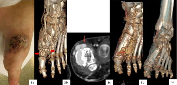 Figure 3: AVM of Foot in 25 years-old man with trophic lesions. a- Trophic lesions and hemorrhage in the medial part of the forefoot b- CT scan vascular 3D: AV shunts inside the first metatarsal, ectasic venous drainage in lateral and medial part of the metaphysis (arrow). c- Initial CT scan osseous reconstruction: venous drainage through a cortical defect in the metaphysis (arrow). d- Persisting AV shunts in the lateral part of metaphysis after incomplete cementoplasty, residual venous drainage outside bone. e- Control after 2nd cementoplasty: no residual AV shunt in metaphysis