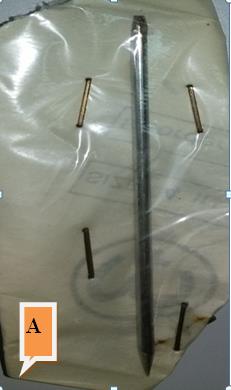 Figure 10: Radiographic image 1st week p. o. of using FGSR in internal fixation of the transverse fracture shows well alignment of fractures bone F. line visible no periosteal reaction appears.