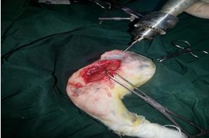 Figure 7: A: Grossly observation for 1 year after sterilization; B: After removing from the fracture case, no change or oxidation or corrosion occurs in the FGSR.