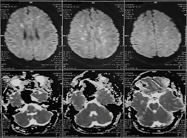 Figure 2: Magnetic resonance imaging showing a star field pattern, with multiple hyper-intense foci against the white matter background.