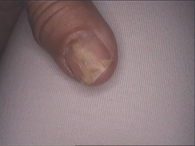Figure 1: Taxane-induced onycholysis in a 45-year-old man causing half nail white detachment, and splinters hemorrhages of several fingers, including the thumbs.