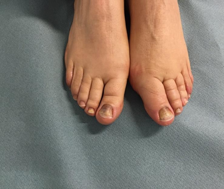 Figure 2: Proximal extension of the onycholysis in a taxane exposed woman.