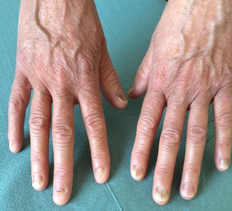 Figure 3: Involvement of the feet in the same patients, with painful subungual hemorrhages and distal onycholysis of the big toes. An additional event is the interaction with ultraviolet radiation for photosensitive chemical agents, resulting in a photo-onycholysis [9]. The nail plate is completely transparent to the light, without natural sunscreen, and may even concentrate the solar radiation acting as a lens, thus reaching the photosensitizers in the nail bed. By chance, this kind of reaction is quite uncommon in respect to the list of drugs potentially able to induced it (Table 2), including out-of-the counter non-steroidal anti- inflammatories. Photo-onycholysis is rare in dark-skinned individuals [8]. Agents most often associated with photo- onycholysis usually cause also systemic photo toxicity, but nails changes can occur after a longer time-lapse and sometimes when the drug has been dismissed, because of the different concentration and persistence of the drug in the nail bad and plate. It usually regresses after discontinuation of the causative agent. Clinical presentation is super imposable to conventional onycholysis, although severe pain and hemorrhagic blisters are more frequent, and thumbs are often spared (Figure 4), probably because of their less directly exposed positioning.Three patterns of photo-onycholysis are described [8] although in our experience, same patient presents with a variable mixture of these findings: Type I: Involvement of several digits, with a distal half- moon shaped detachment surrounded by a well- demarcated pigmented zone. Type II: Only one digit is involved and present as a proximal circular notch. Type III: Several digits are involved, but changes are located in the central part of the nail bed, usually associated with subungual hemorrhages.