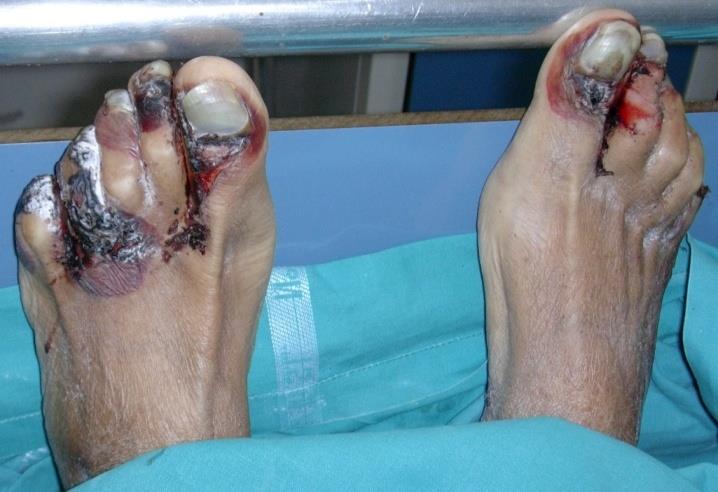 Figure 5: Severe onycholysis of the feet in a patient with Toxic Epidermal Necrolysis.