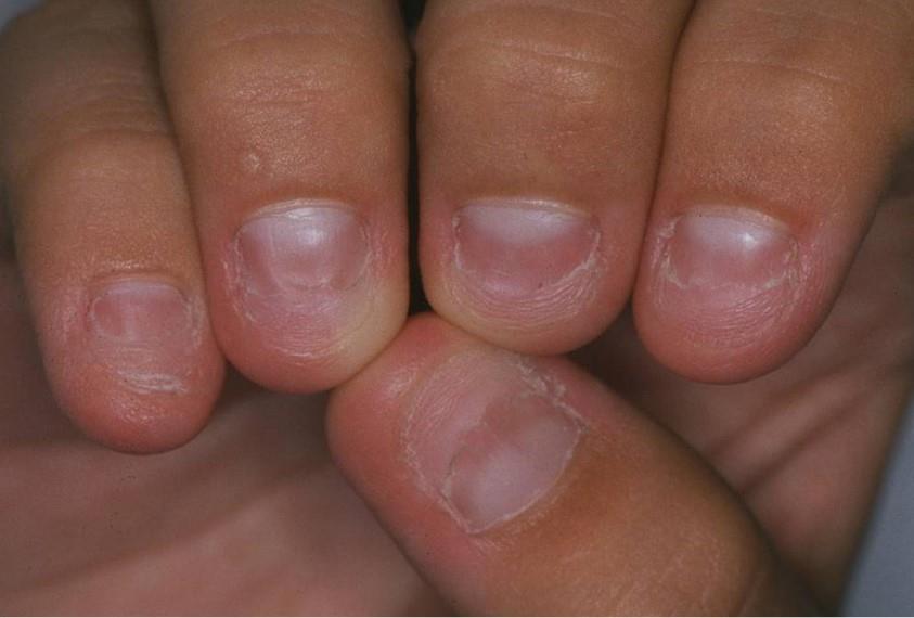 Figure 6: Onycholysis recovery, with detached portions regularly clipped until complete adhesion of the nail plate to the nail bed.
