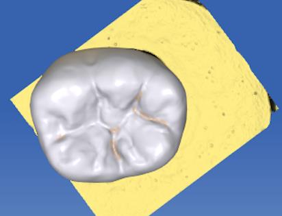 Figure 2: Design of crown in the CAD/CAM machine.