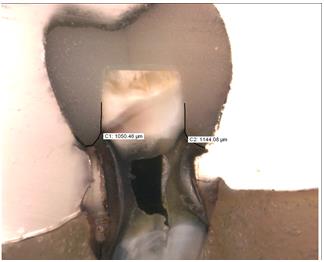 Figure 5: Extent of dye penetration in a sectioned tooth under stereomicroscope.