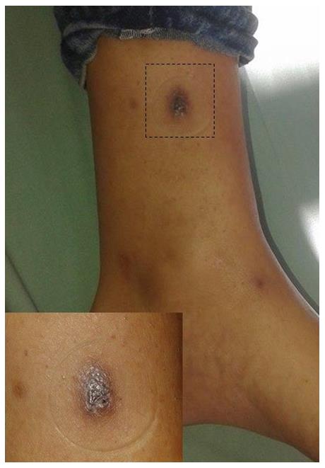 Figure 1: Violaceous tumoral lesion on the left leg.