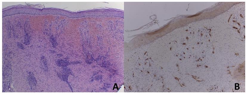 Figure 3: Histopathological image: Dermal scar fibrosis. A) H/E 4X B) CD34 10X.