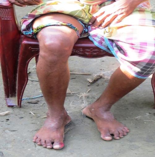 Figure 1: Victim bitten on his right toe (circled) and a tourniquet tied up on his right thigh (arrow).