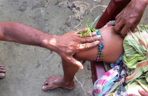 Figure 10: The ‘ojhas’ hand now at the place of the tourniquet following snakebite.