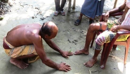 Figure 7: Hand of the ‘ojha’ near the bitten toe of the snake-bitten person.