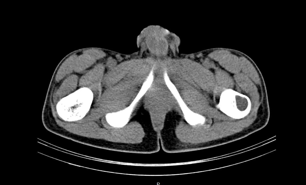 Figure 1: Primary hyperparathyroidism investigations in the proband. 1A: Phosphocalcic metabolism investigations before and after surgery (February 2010).