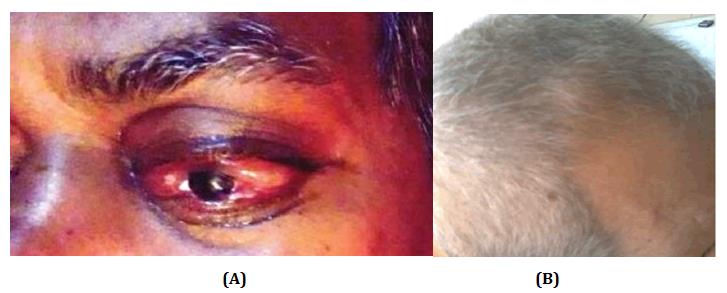 Figure 1: Initial presentation of patient with (A) swelling and buldging of left orbit, (B) swelling at scalp region.