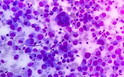 Figure 3: MGG (10x40) dispersed immature plasma cell with binucleate to multi-nucleate cells in a highly cellular smear from the patient of plasmacytoma.