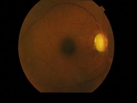 Figure 1: Left eye optic atrophia (Case 1).