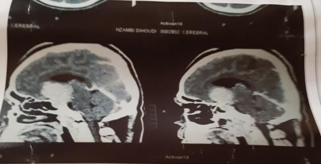 Figure 3: Brain CT-scan in coronal section showing sellar tumor with temporal expansion on the right (Case1).