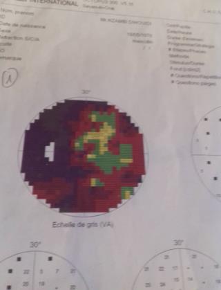 Figure 4: Left eye papillary edema stage II (Case 2).