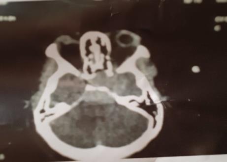 Figure 6: Brain CT-scan in coronal section showing a giant tumor going totaly over the pituitary fossa (Case 2).