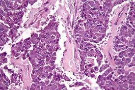Figure 2: Acinar carcinoma pancreas with foci of glandular differentiation, uniform cells with abundant eosinophilic cytoplasm, atypical basal nuclei and minimal stroma [10].