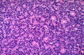 Figure 5: Mucinous cystic variant of carcinoma pancreas with inner epithelial layer, outer densely cellular mullerian layer and mucin secretion [11].