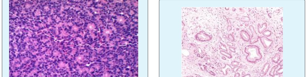 Figure 6: Carcinoma pancreases with neuro- ectodermal differentiation with small, round, uniform cells, glandular configuration and enveloping fibro- vascular stroma [12].