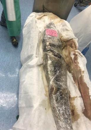 Figure 7: A fresh body in a cadaver body bag.