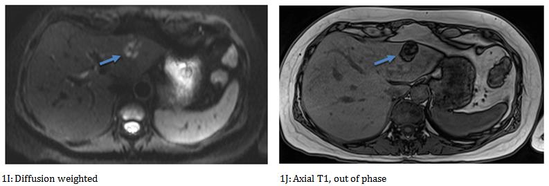 Figure 2: CT scan- Computed tomography of ambdomen in simple phase Axial cut, a solid-looking image is identified, with heterogeneous attenuation values due to the presence of fat and soft tissue densities; predominantly hypodense, located in the segment II.