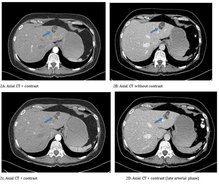 Figure 3: Ultrasound- Image of nodular appearance, solid, ecogenic (due to fat content) or heterogeneous echogenicity in the segment II of the liver (blue arrow). In case the lesion has low lipid content and high vascular content, the angiomyolipoma may be hypoechoic. At color doppler titration, there is an increase in vascular flow (3B).