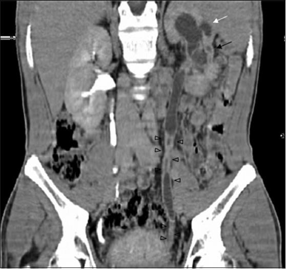 Figure 4: CT revealing multiplicity of findings in urinary TB-uneven caliectasis with no obvious pelvic dilatation, parenchymal scarring (black arrow), and cavity communicating with PCS (white arrow), urothelial thickening and multiple ureteral strictures (black arrowheads) [15].