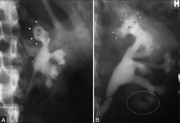 Figure 6: Genitourinary tract tuberculosis. Intravenous urography series in a man with renal tuberculosis shows marked irregularity of the bladder lumen due to mucosal edema and ulceration [17].