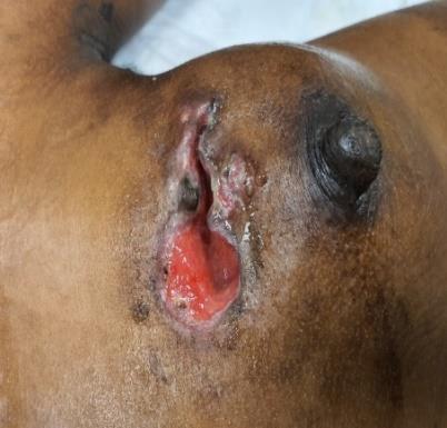 Figure 1: Ulcerate and Necrotic Left Breast Cancer.