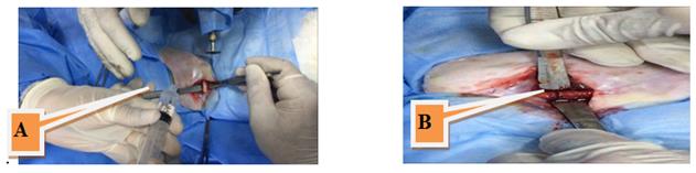 Figure 2: A. Induce fracture by using electrical saw, and dropping normal saline to prevent thermal necrosis of bone; B. create complete transverse midshift femoral fracture.