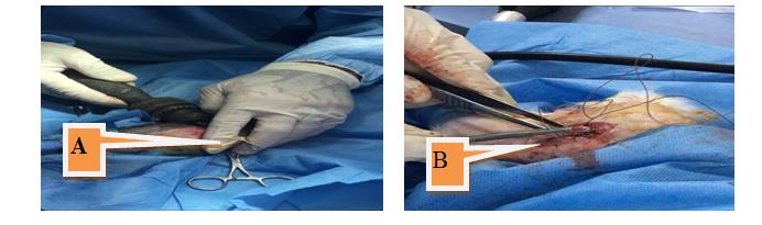 Figure 3: A. insert the FGSR inside the marrow canal for internal fixation using pin chock; B. Close the surgical incision.
