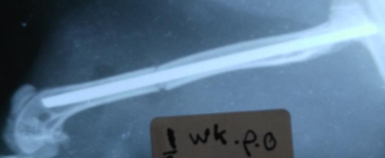 Figure 5: Radiographic finding end of 1st week p.o. revealed, well alignment of the fracture fragments and well-fixed with FGSR, with smooth and still visible fracture line.