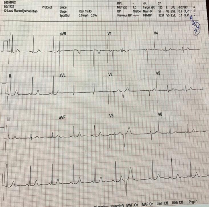 Figure 1: Baseline ECG.