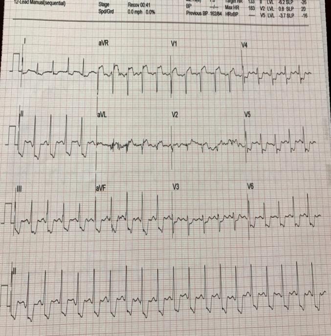 Figure 2: ECG: 40 seconds into recovery after 4 min of exercise: Marked ST elevation in aVR, more than in V1. Marked down sloping ST depression inferolaterally.