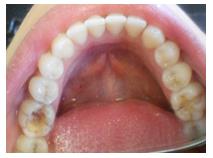 Figure 1: Clinical condition of tooth #46 with large access cavity and the crack of mesial wall.