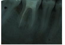 Figure 2: Periapical radiographic.