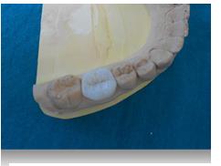 Figure 6: Fitting the restoration on the model. A total etch dual cure resin (Variolink II, Ivoclar/Vivadent, Liechtenstein) was used. Bonding procedures were carried out starting with the treatment of the restoration: the inner face of the glassy endocrown was etched with hydrofluoric acid for 20s (Dentobond Porcelain Fix, Itena, France) followed by rinsing with distilled water, dried and coated with silane application, thinning with a gentle air stream for 60 seconds (Figures 7 & 8).